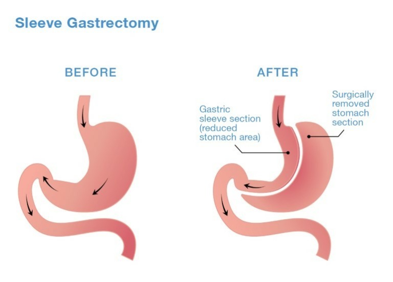 Reflux After Sleeve Gastrectomy - Bariatric Surgery