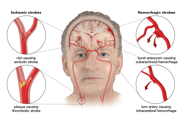 a diagram of ischemic and hemorrhagic strokes